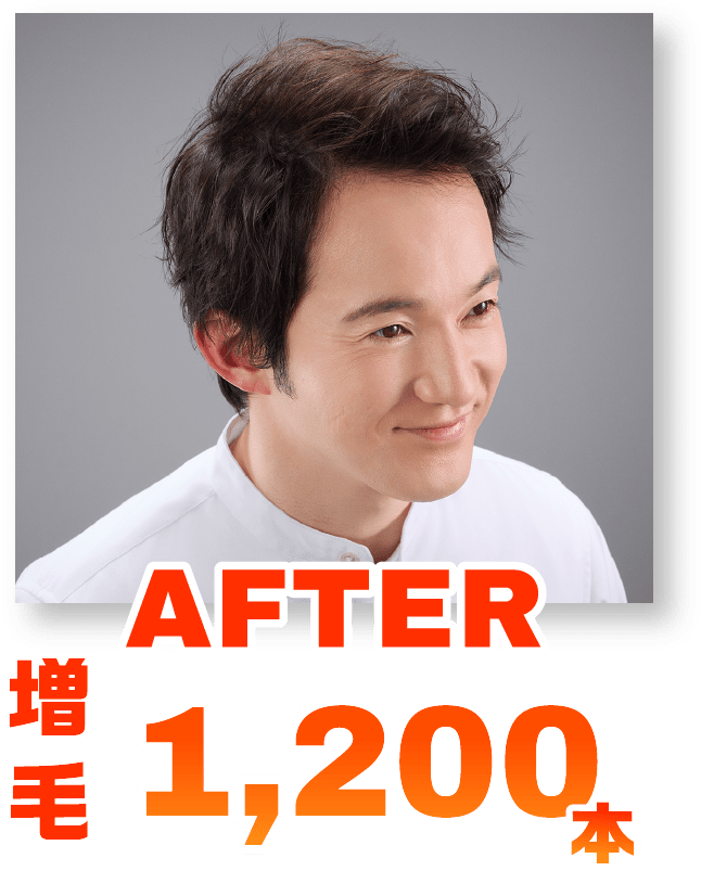 AFTER増毛1,200本