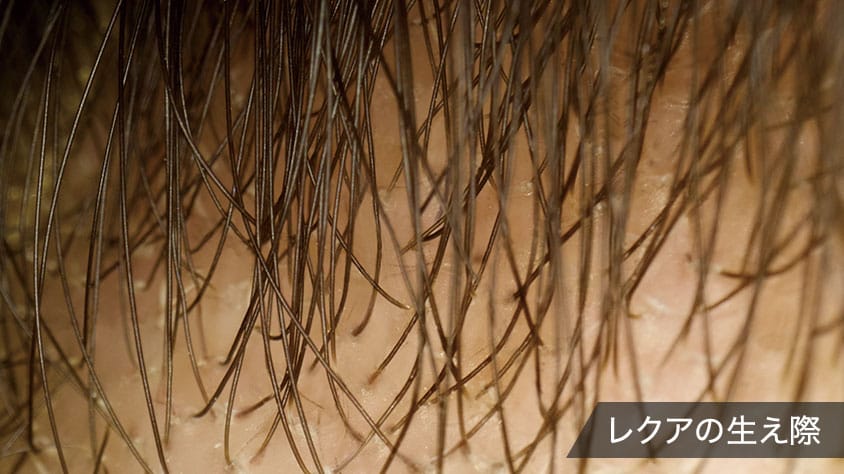 レクアの生え際