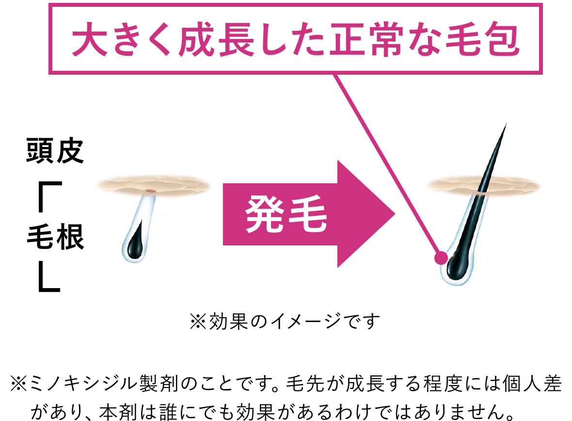 発毛剤に配合されている有効成分ミノキシジル※は毛包に直接作用して、細胞の増殖やタンパク質の合成を促進することによって、発毛及び毛髪の成長を促します。